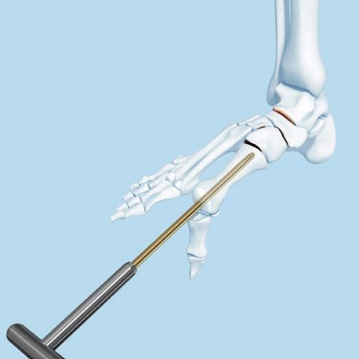 Implantation 7a Insert the midfoot fusion bolt Insert the midfoot fusion bolt into metatarsal head. Use image intensification to visualize and control bolt insertion.