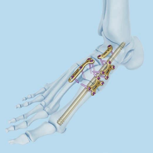 Supplemental Fixation The Midfoot Fusion Bolt is to be used with supplemental fixation, such as additional screws and plates across the arthrodesed joints.