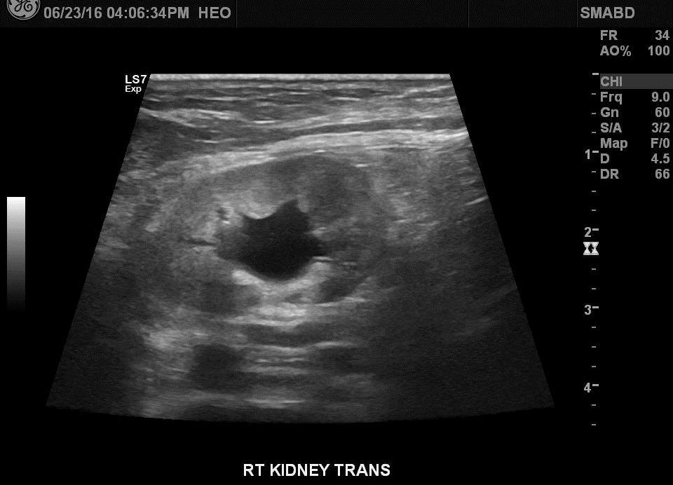 ULTRASOUND >10cm: likely complete/near complete obstruction 5-10mm: gray zone, dependent on