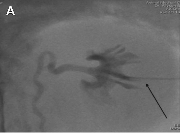 PERCUTANEOUS ANTEGRADE PYELOGRAPHY Visualize the renal pelvis and ureter Localize