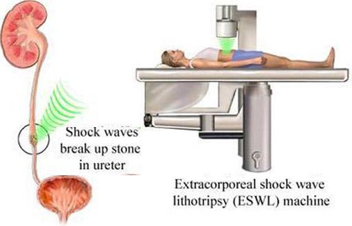 EXTRACORPOREAL SHOCK WAVE