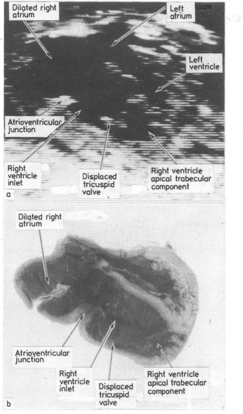 2 Echocardiogram (a) and postmortem dissection (b) of heart ofsame fetus (case 15) in four chamber plane showing the displacement of the tricuspid valve and dilataton of the nght atrium, typical