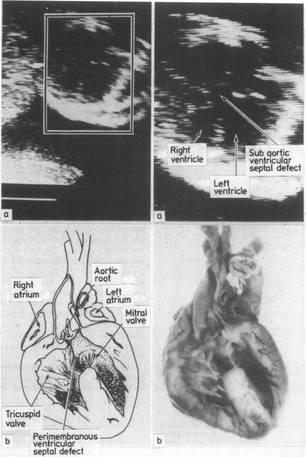 546 I --~ Perirnembranous ventricular septa[ defect Fig. 3 Echocardiograms (and enlargement) (a) and postmortem dissections (b) showing a large perimembranous inlet septal ventricular defect.