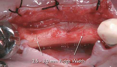 Once implant positions were confirmed, a horizontal ridge split to a 10-mm depth was created using Piezosurgery (Piezosurgery Incorporated) to allow further buccal plate flexibility.