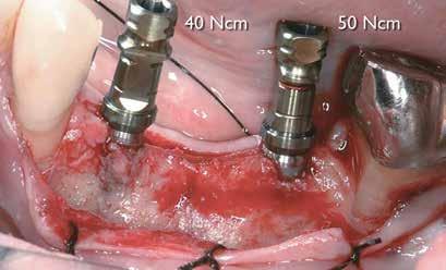 Two 3.7/13 Tapered Screw-Vent implants (Zimmer ) were placed with an insertion torque of 40-50 Ncm. Both implants total lengths were covered with autogenous bone. Less than 1.