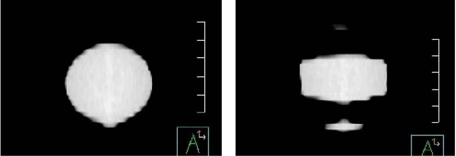 Pre-imaging: 4D CT Respiratory motion causes artifacts during 3D CT Errors in position, shape and volume information for the target volume and critical structures Respiratory motion