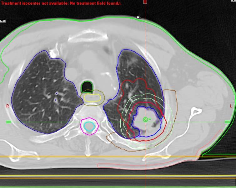 CT, Lung
