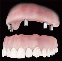 CONUS CONCEPT HYBRID DENTURE Vertical requirements Disadvantages Requirements Protocol Full or partial arch 15mm minimum above implant sites Restore with or without vestibule.