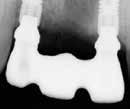 Abutment or implant level At time of publication only available for 2 or more