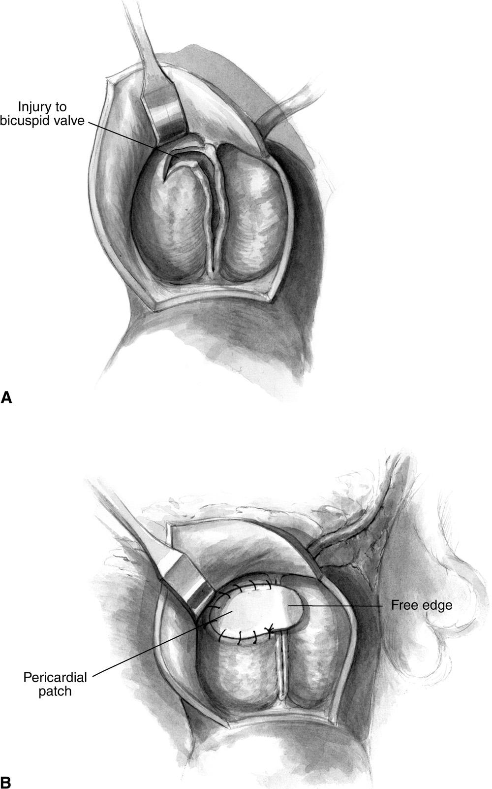 Aortic valve repair in children 245 Figure 2 This figure depicts the typical findings in a child with aortic stenosis who has previously undergone balloon aortic valvulotomy and is suffering from