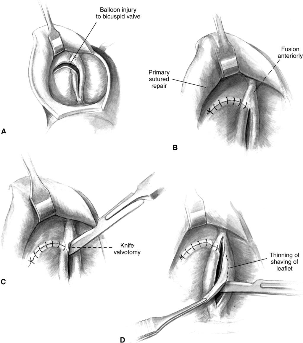 246 A.K. Kaza and J.A. Hawkins Figure 3 This figure depicts another approach to repair of aortic valve insufficiency following balloon valvulotomy.