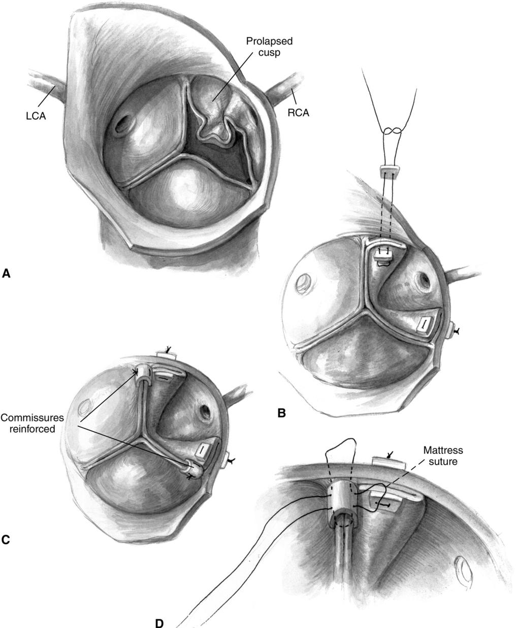 Aortic valve repair in children 249 Figure 6 This figure depicts the repair of aortic valve insufficiency that originates from a prolapsing, redundant valve leaflet that was initially reported by
