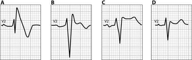 Interpretation of 12-lead ECG in the athlete 255 Figure 7 Patterns of Brugada ECG. Type 1 Brugada ECG is characterized by a coved ST-segment elevation 2 mm (0.2 mv) followed by a negative T wave (A).