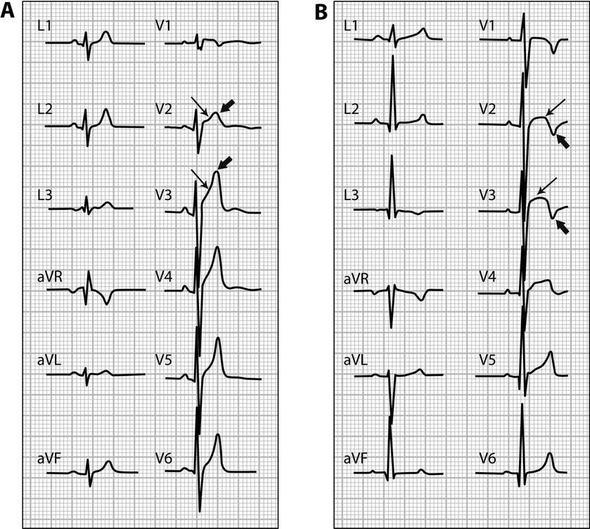 248 D. Corrado et al. Figure 2 Different patterns of precordial early repolarization in two healthy athletes.