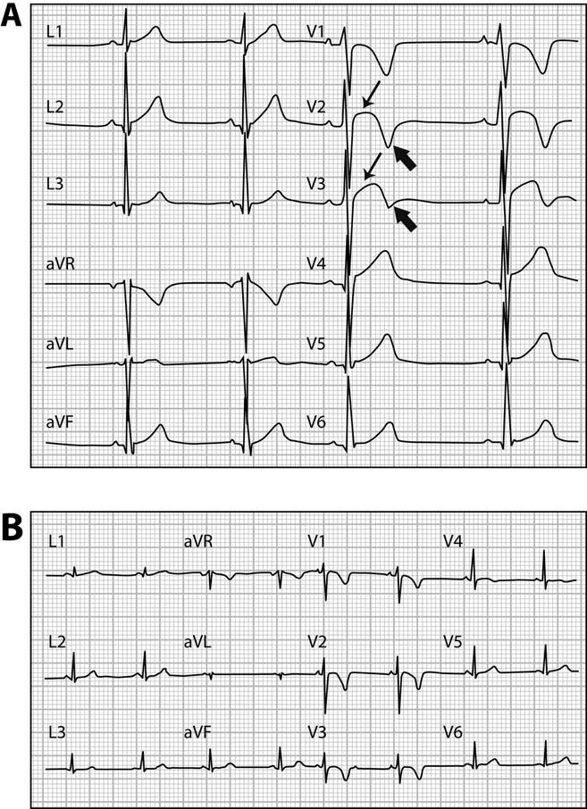 Interpretation of 12-lead ECG in the athlete 249 Figure 3 (A) Early repolarization pattern in a healthy black athlete characterized by right precordial T-wave inversion (arrowhead) preceded by