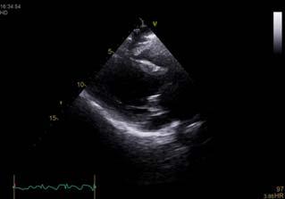 Question 8: A 78 year old patient presents with syncope and is found to have transient complete heart block.