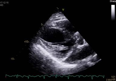 Answer : C agitated saline contrast through left arm showing persistent LSVC. Important pre pacemaker implantation Question 9: A patient has the following quantitative measures of RV function.