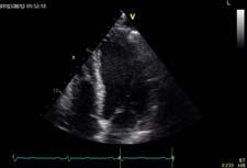 Answer - 4 All of the above indicate significant RV systolic dysfunction.