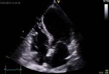 likely to be represented? 1 2 1. Acute Pulmonary Embolism 2.