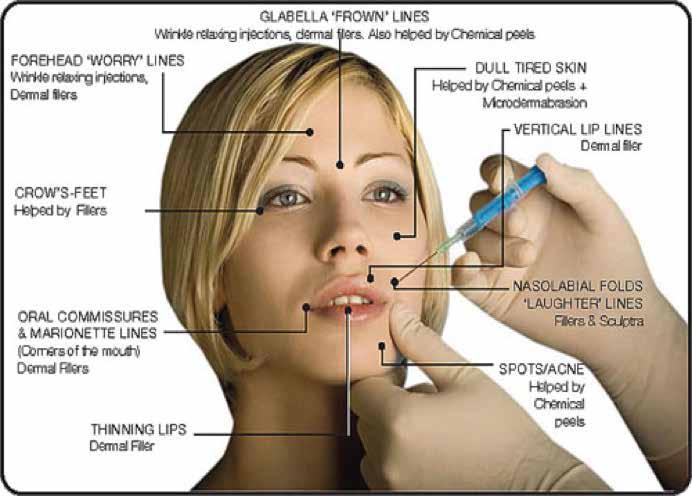 This diagram shows where you can use BOTOX For further information on Botox please
