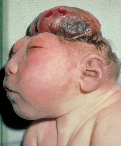 Anencephaly incompatible