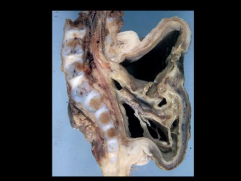 Meningomyelocele Occurs in lumbar sacral region Associated with
