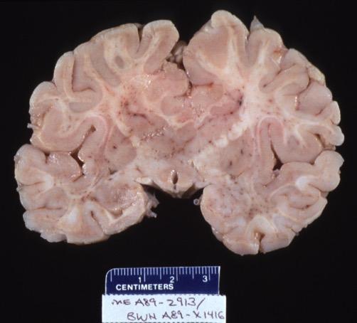 Holoprosencephaly Failure of formation of the forebrain