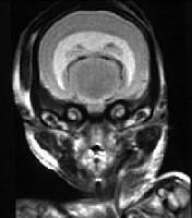 (cyclopia) Associated with mutations of SHH, Zic2, other
