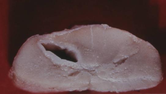 Syringomyelia a fluid-filled cleft within the cord