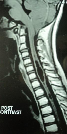 cervical cord commonly involved Cyst expands during life