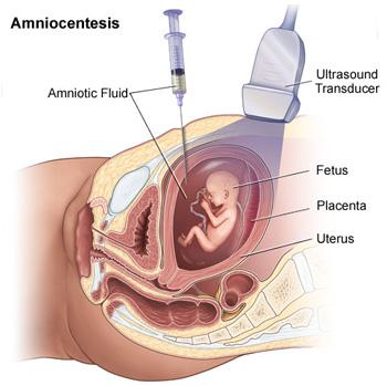 Ultrasound(20 weeks) Chromosome