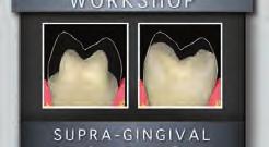 the Supra-gingival workshop, fixed prosthetics has truly become simplified and much