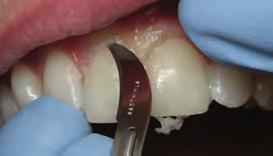 Supra-gingival dentistry by observing a live procedure and performing, onlay and