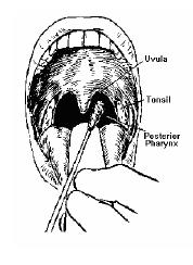 Posterior pharyngeal swab (throat swab) Hold the tongue out of the way