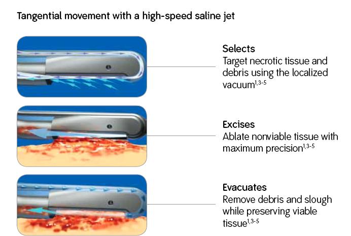 Precision and control The VERSAJET system uses a highpressure stream of saline to optimize surgical debridement.