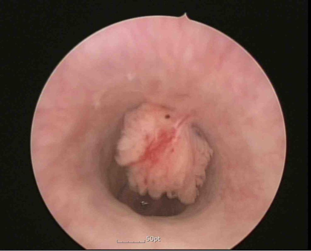 DISCUSSION DCP manifests as a worm-like shape helophytic, villous/polyploidy growth by cystoscopy, and is mainly found around the urethra and verumontanum.