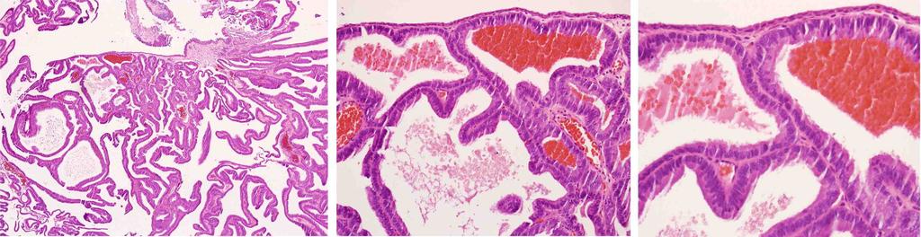 Metachronous anterior urethral metastasis of prostatic ductal adenocarcinoma Fig. 3.