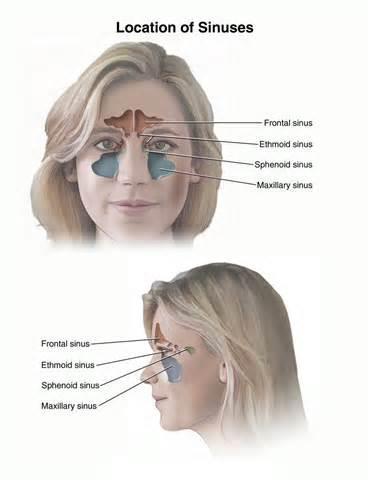 Sinus headaches Sinus headaches are headaches that may accompany sinusitis, a condition in which the