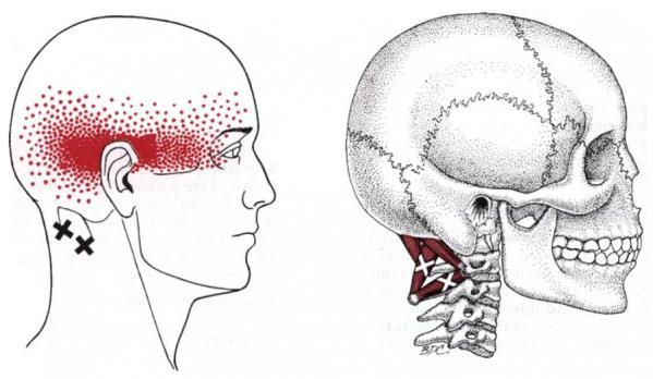 Suboccipital muscles Obliquus Capitis Inferior (also known as the Inferior Oblique) is a small muscle that runs posteriorly and inferomedially from C1 to C2.