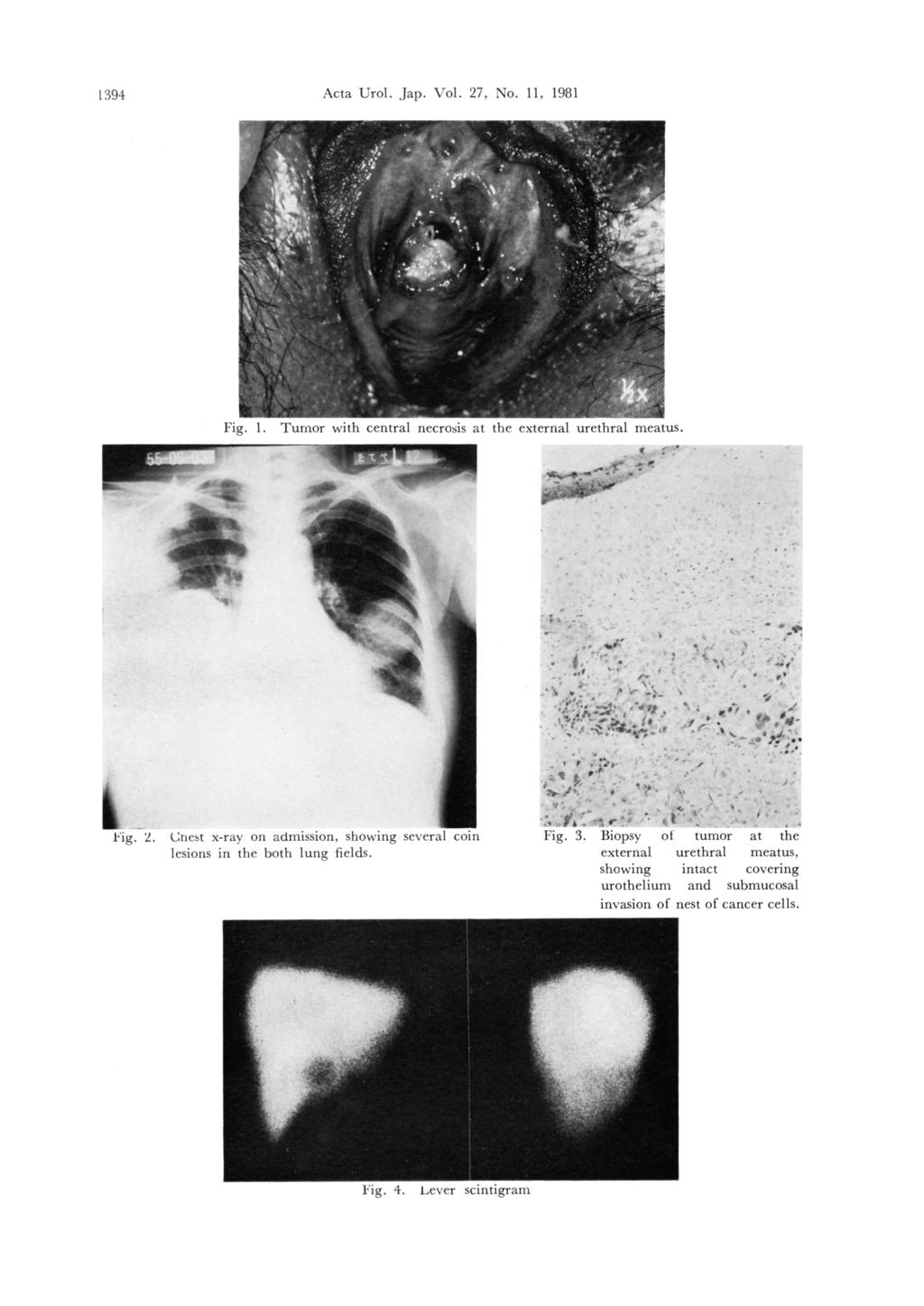 Acta Tirol. 1394 Jap. Vol. 27. No. 11. 1981.- v / 6. ` ` rt. f 4-. l r1~, 1. Tumor with central necrosis at external tt meatus. I ha * M! ~ m r~~a r. _. s,i(.t ~! - 2.