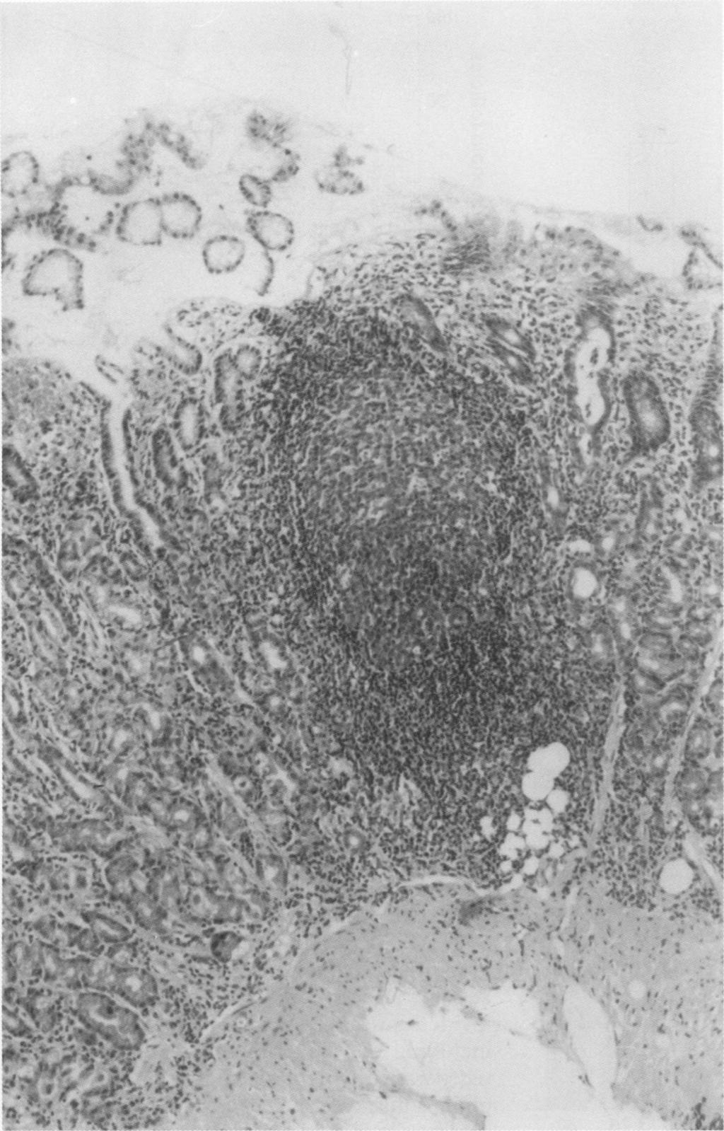 Lymphoid follicles in H pylori gastitis 4. 4.i,.1. '.,",.1- - '.....4 "I., I on Figure 3 Secondary lymphoid follicle in a biopsy specimen with H pylori associated gastritis (haematoxylin and eosin).