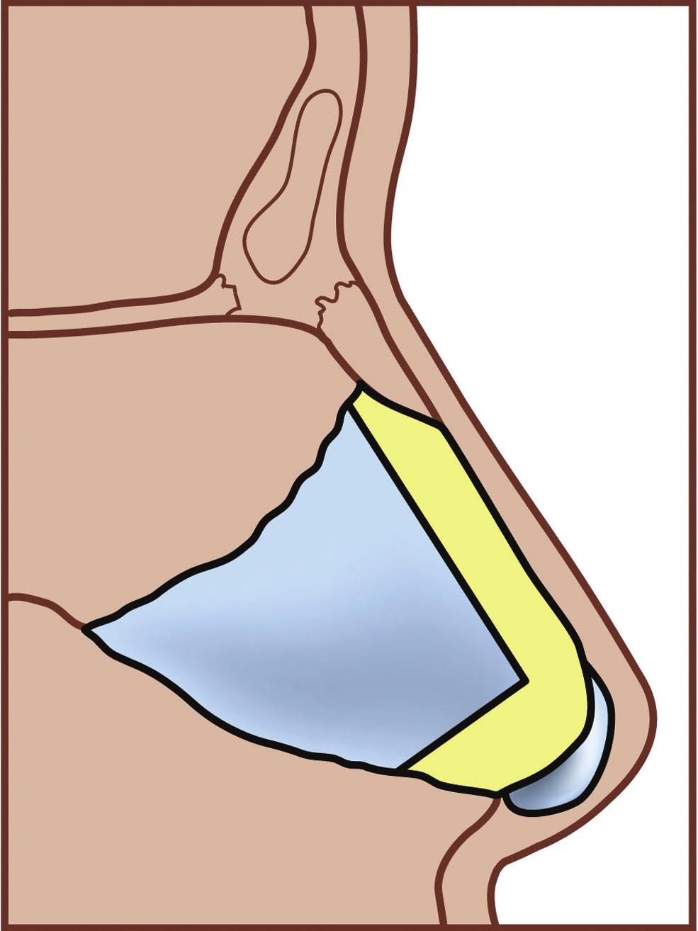 This poorly understood vasoerectile structure has been localized to the region anterior to the middle turbinate, above the nasal floor, and caudally approaching the nasal valve region.