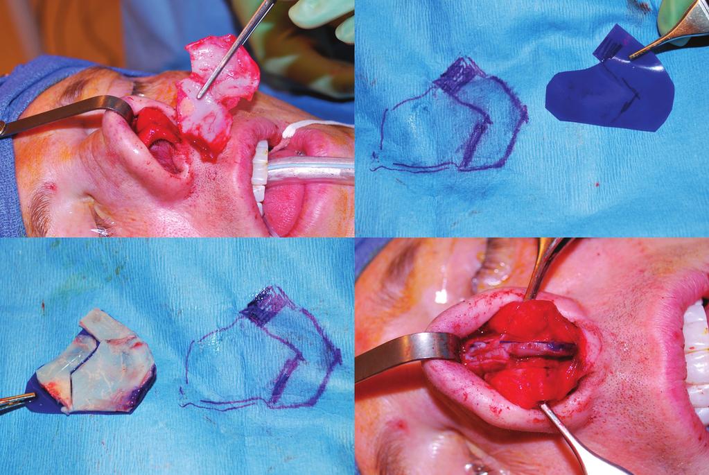 Figure 3. (Upper left) During extracorporeal septoplasty the quandrangular cartilage is resected en bloc. (Upper right) The PDS Flexible Plate (Ethicon Inc.