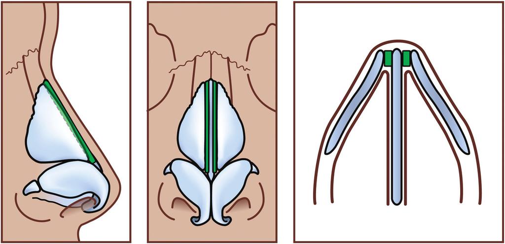 (Lower right) The reconstructed septum is secured to the maxillary crest and nasal dorsum. Figure 4. Spreader grafts are depicted here in lateral, frontal and in cross-sectional views.