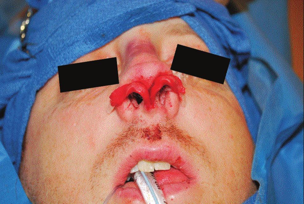 necessary to maintain a continuous flap through the dense decussating fibers. The redundant cartilage is resected, leaving the caudal septum only attached superiorly.