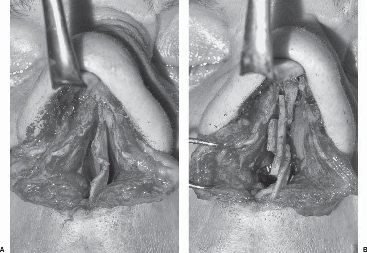 The first phase of the septal crossbar graft technique involves a series of incisions in both the dorsal and the caudal pillar of the L strut.