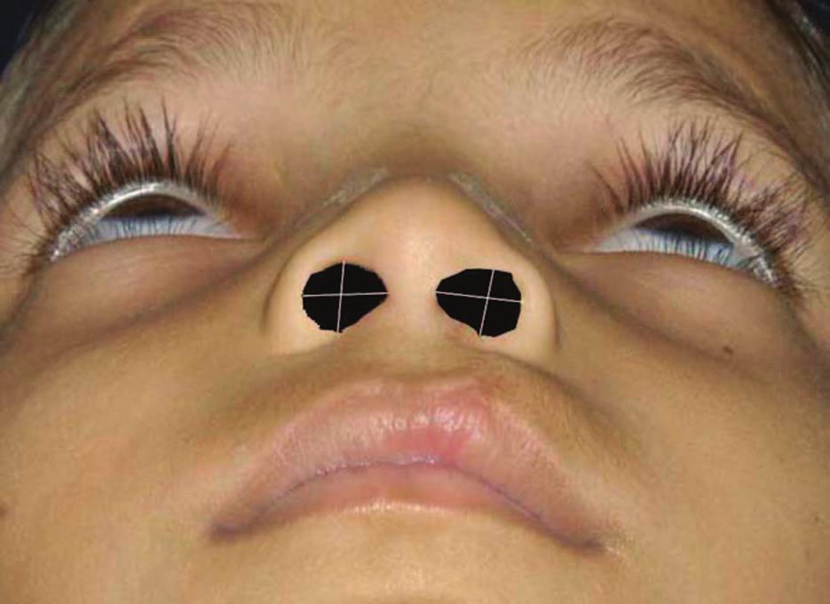 Volume 127, Number 2 Nasal Symmetry after Cleft Lip Repair Fig. 1. Nostril gap area is measured in square millimeters using Scion Image software with Adobe Photoshop.