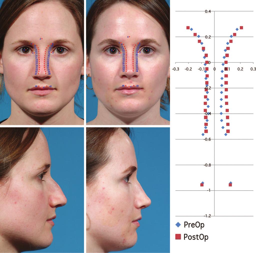 Volume 128, Number 1 Dorsal Aesthetic Lines in Rhinoplasty Fig. 4. A patient from the wider group is shown.