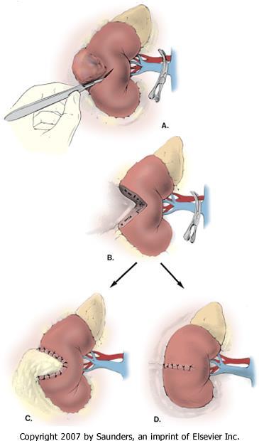 Open Partial Nephrectomy A.