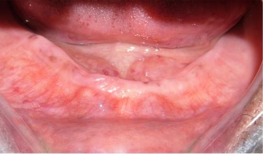 4 CASE REPORT A 65 year old male patient presented with completely edentulous upper and